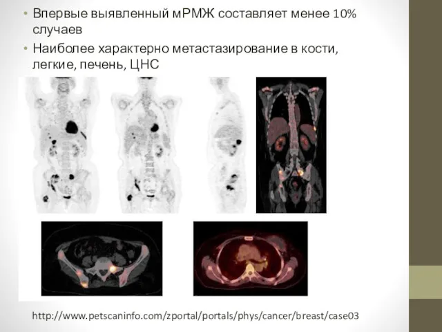 Впервые выявленный мРМЖ составляет менее 10% случаев Наиболее характерно метастазирование в кости, легкие, печень, ЦНС http://www.petscaninfo.com/zportal/portals/phys/cancer/breast/case03
