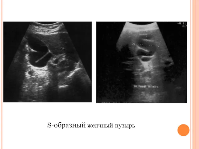 S-образный желчный пузырь