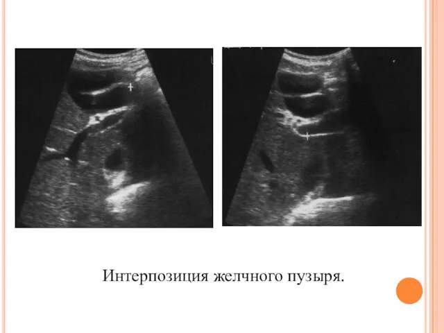 Интерпозиция желчного пузыря.