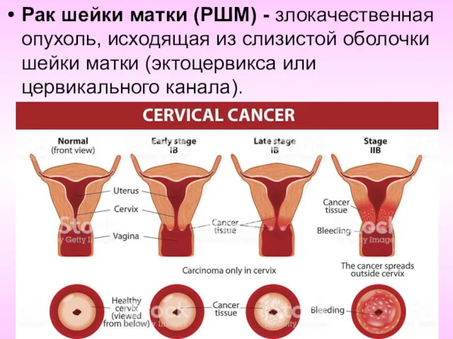 Рак шейки матки (РШМ) - злокачественная опухоль, исходящая из слизистой оболочки шейки матки
