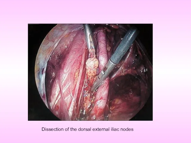 Dissection of the dorsal external iliac nodes