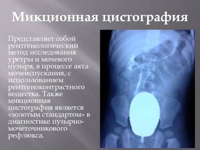Микционная цистография Представляет собой рентгенологический метод исследования уретры и мочевого