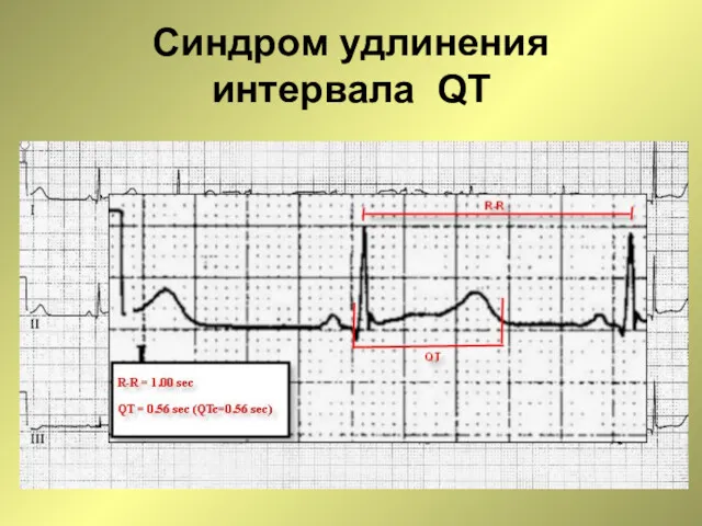 Синдром удлинения интервала QT