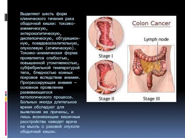 Выделяют шесть форм клинического течения рака ободочной кишки: токсико-анемическую, энтероколитическую, диспепсическую, обтурацион-ную, псевдовоспалительную,