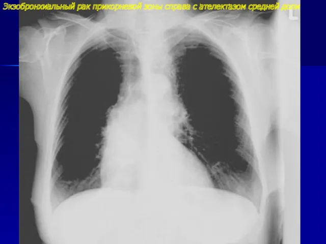 Экзобронхиальный рак прикорневой зоны справа с ателектазом средней доли
