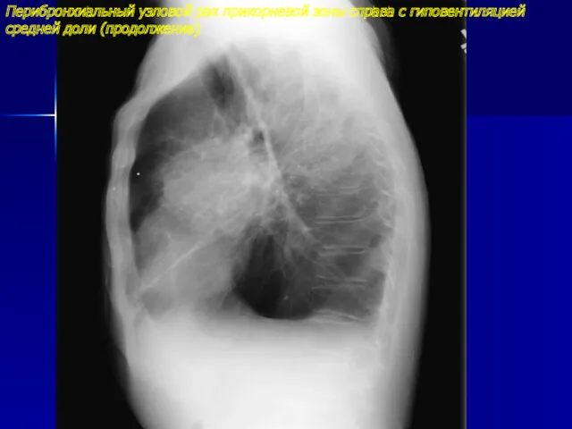 Перибронхиальный узловой рак прикорневой зоны справа с гиповентиляцией средней доли (продолжение)