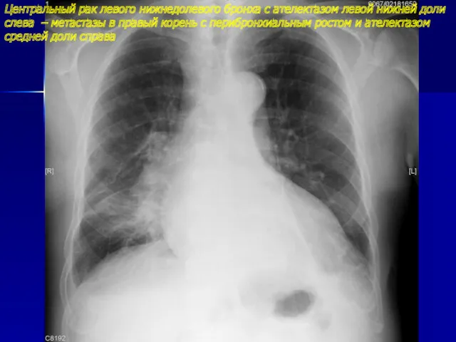 Центральный рак левого нижнедолевого бронха с ателектазом левой нижней доли слева – метастазы