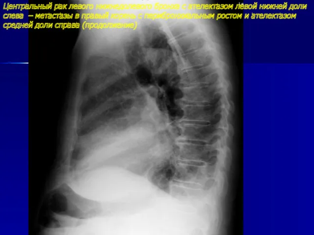 Центральный рак левого нижнедолевого бронха с ателектазом левой нижней доли слева – метастазы