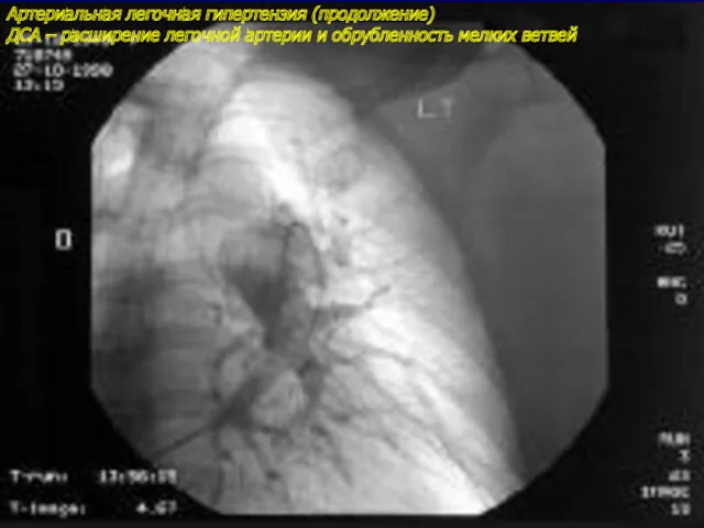 Артериальная легочная гипертензия (продолжение) ДСА – расширение легочной артерии и обрубленность мелких ветвей