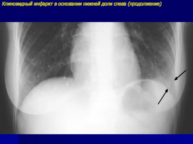 Клиновидный инфаркт в основании нижней доли слева (продолжение)