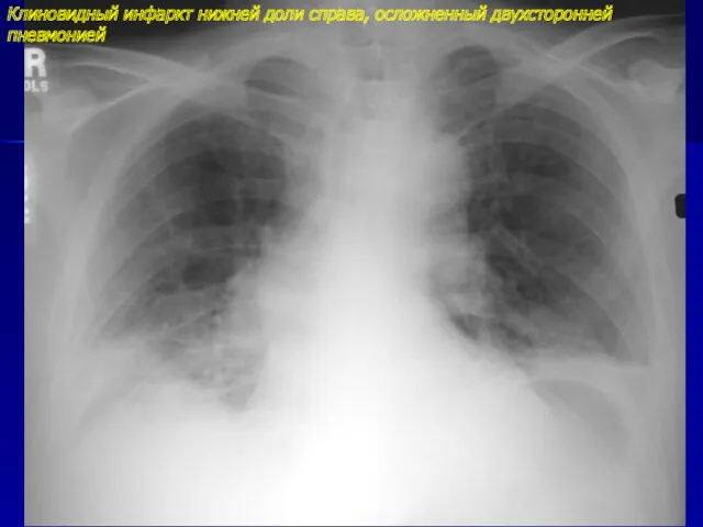 Клиновидный инфаркт нижней доли справа, осложненный двухсторонней пневмонией