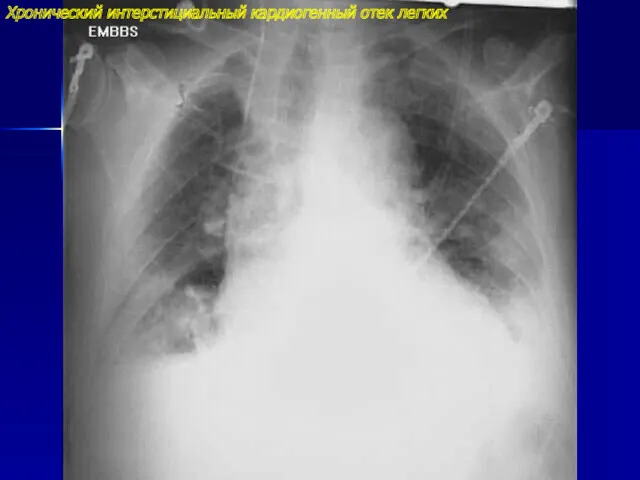 Хронический интерстициальный кардиогенный отек легких