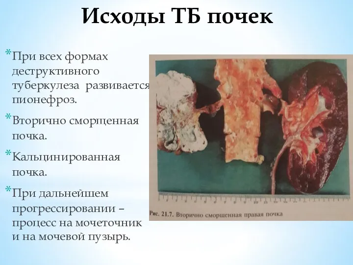 Исходы ТБ почек При всех формах деструктивного туберкулеза развивается пионефроз.