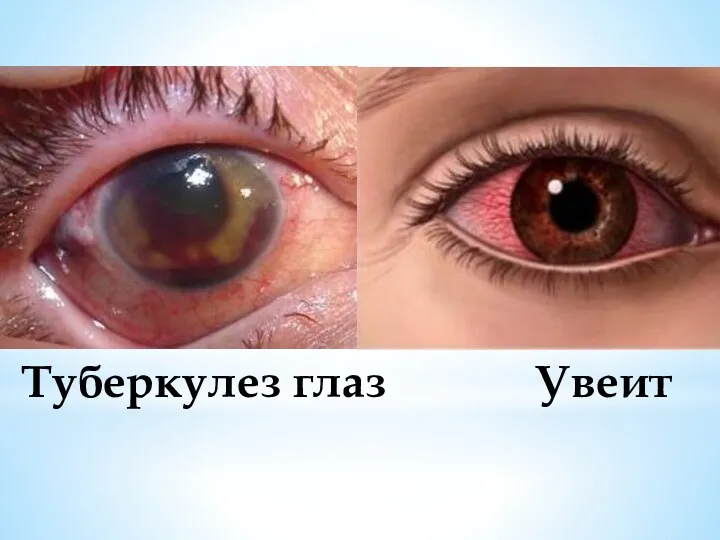 Туберкулез глаз Увеит