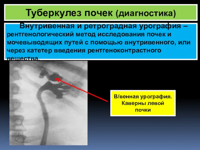 Туберкулез почек (диагностика) Внутривенная и ретроградная урография – рентгенологический метод