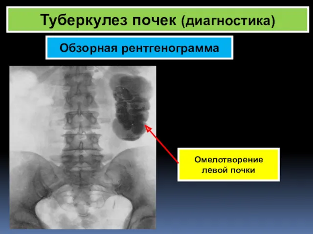 Туберкулез почек (диагностика) Обзорная рентгенограмма Омелотворение левой почки