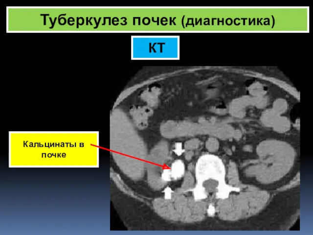 Туберкулез почек (диагностика) КТ Кальцинаты в почке