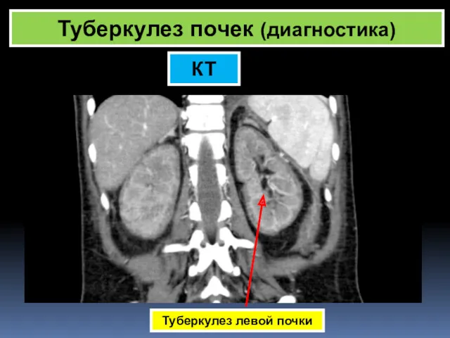 Туберкулез почек (диагностика) КТ Туберкулез левой почки