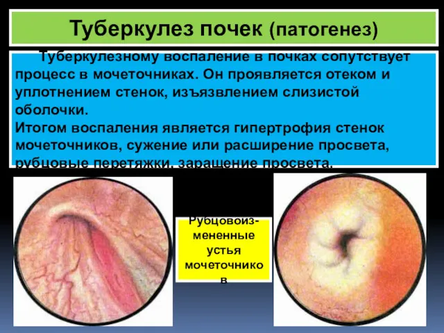 Туберкулез почек (патогенез) Рубцовоиз- мененные устья мочеточников Туберкулезному воспаление в