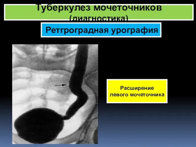 Туберкулез мочеточников (диагностика) Расширение левого мочеточника Ретгроградная урография