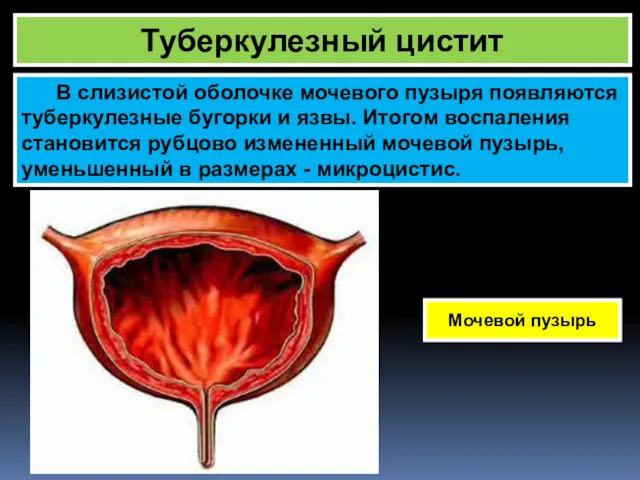Туберкулезный цистит В слизистой оболочке мочевого пузыря появляются туберкулезные бугорки