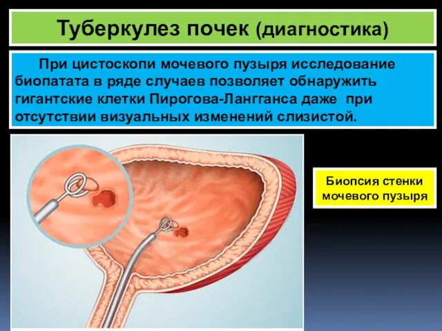 Туберкулез почек (диагностика) При цистоскопи мочевого пузыря исследование биопатата в