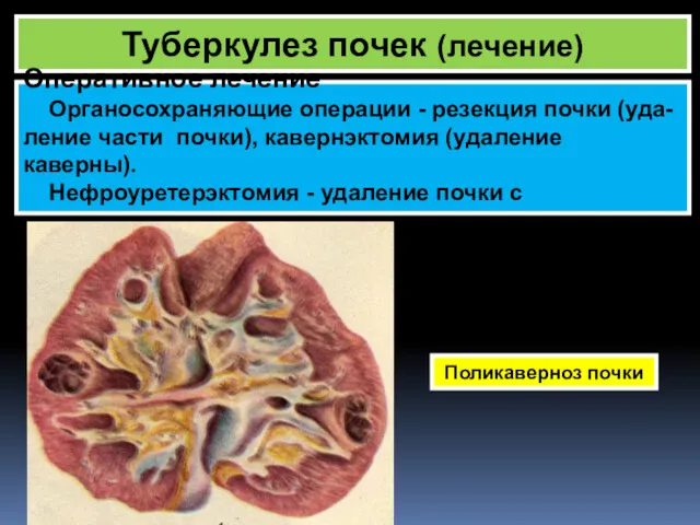 Туберкулез почек (лечение) Поликаверноз почки Оперативное лечение Органосохраняющие операции -