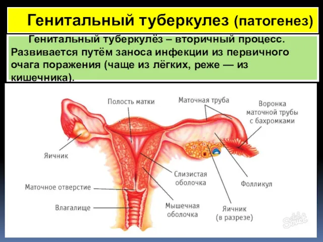 Генитальный туберкулез (патогенез) Генитальный туберкулёз – вторичный процесс. Развивается путём