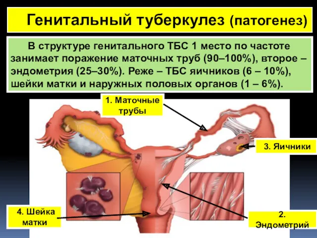 Генитальный туберкулез (патогенез) В структуре генитального ТБС 1 место по
