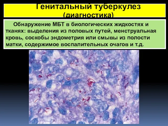 Генитальный туберкулез (диагностика) Обнаружение МБТ в биологических жидкостях и тканях: