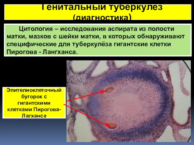 Генитальный туберкулез (диагностика) Цитология – исследования аспирата из полости матки,