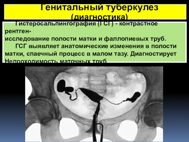 Генитальный туберкулез (диагностика) Гистеросальпингография (ГСГ) - контрастное рентген- исследование полости