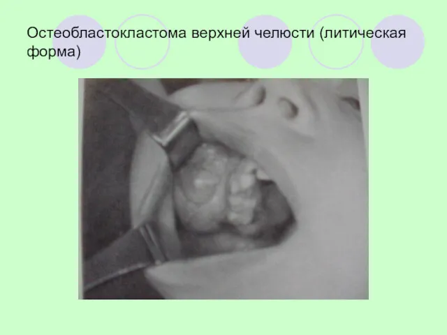 Остеобластокластома верхней челюсти (литическая форма)