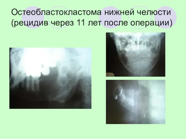 Остеобластокластома нижней челюсти (рецидив через 11 лет после операции)