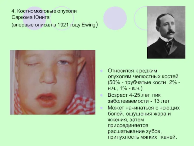 4. Костномозговые опухоли Саркома Юинга (впервые описал в 1921 году