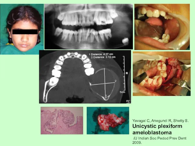 Yavagal C, Anegundi R, Shetty S. Unicystic plexiform ameloblastoma //J Indian Soc Pedod Prev Dent 2009.