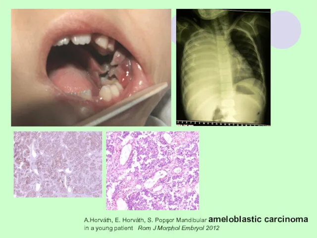 A.Horváth, E. Horváth, S. Popşor Mandibular ameloblastic carcinoma in a