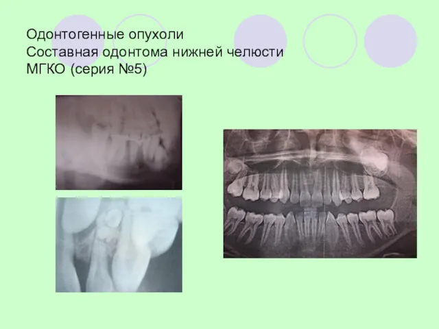 Одонтогенные опухоли Составная одонтома нижней челюсти МГКО (серия №5)
