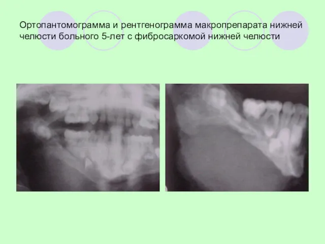 Ортопантомограмма и рентгенограмма макропрепарата нижней челюсти больного 5-лет с фибросаркомой нижней челюсти
