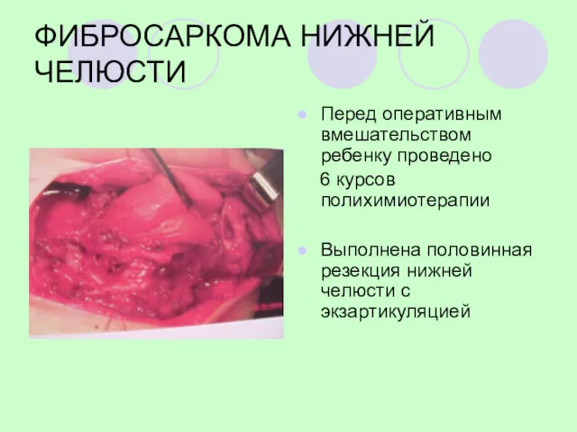 ФИБРОСАРКОМА НИЖНЕЙ ЧЕЛЮСТИ Перед оперативным вмешательством ребенку проведено 6 курсов