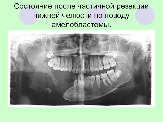 Состояние после частичной резекции нижней челюсти по поводу амелобластомы.