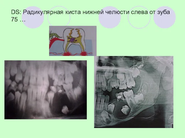 DS: Радикулярная киста нижней челюсти слева от зуба 75 …