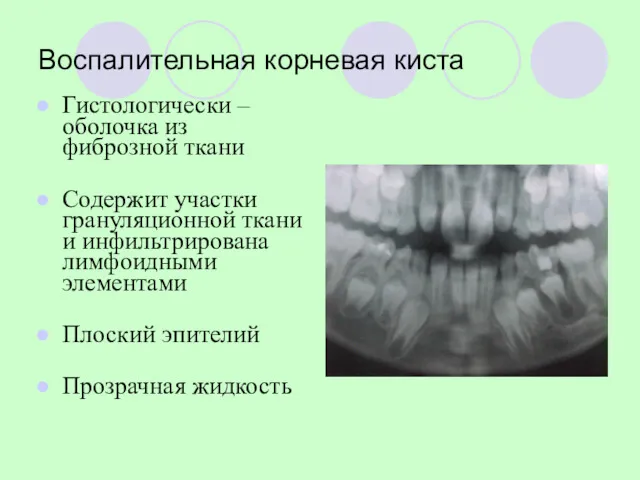 Воспалительная корневая киста Гистологически – оболочка из фиброзной ткани Содержит