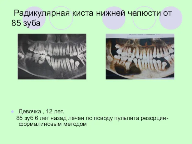 Радикулярная киста нижней челюсти от 85 зуба Девочка , 12