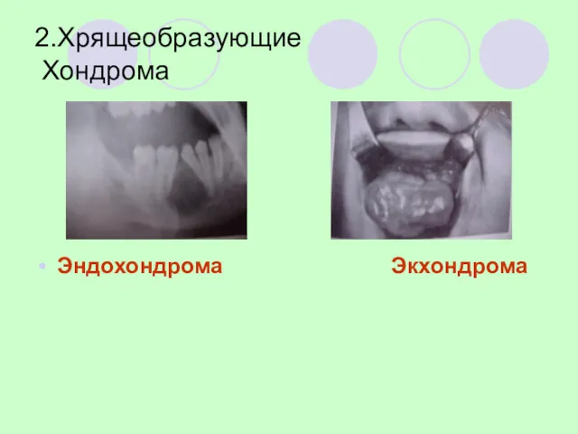 2.Хрящеобразующие Хондрома Эндохондрома Экхондрома