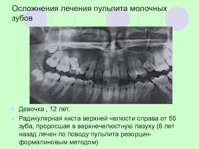 Осложнения лечения пульпита молочных зубов Девочка , 12 лет. Радикулярная