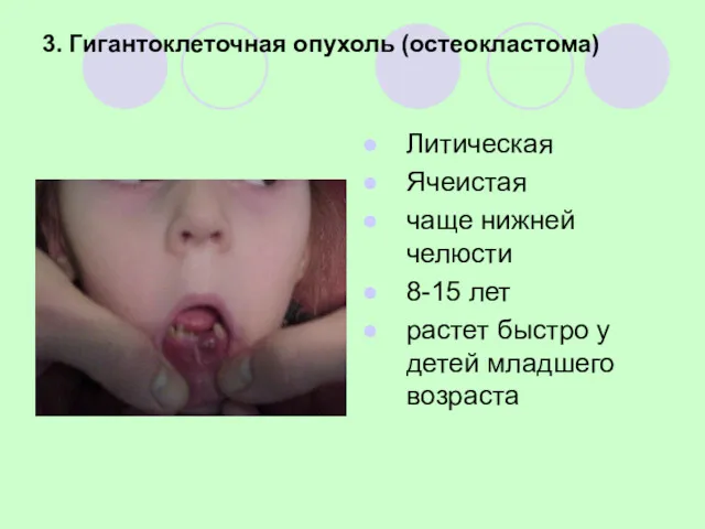 3. Гигантоклеточная опухоль (остеокластома) Литическая Ячеистая чаще нижней челюсти 8-15
