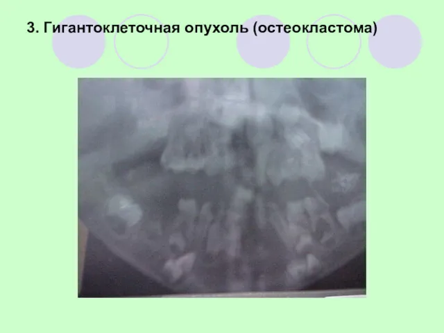 3. Гигантоклеточная опухоль (остеокластома)