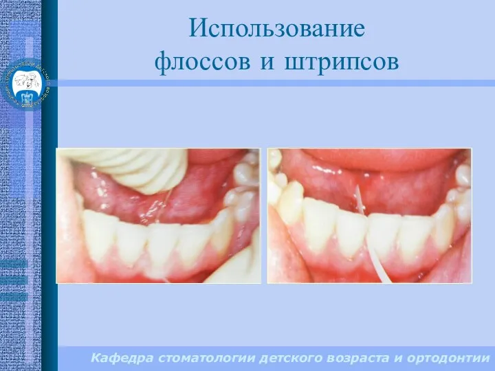 Кафедра стоматологии детского возраста и ортодонтии Использование флоссов и штрипсов