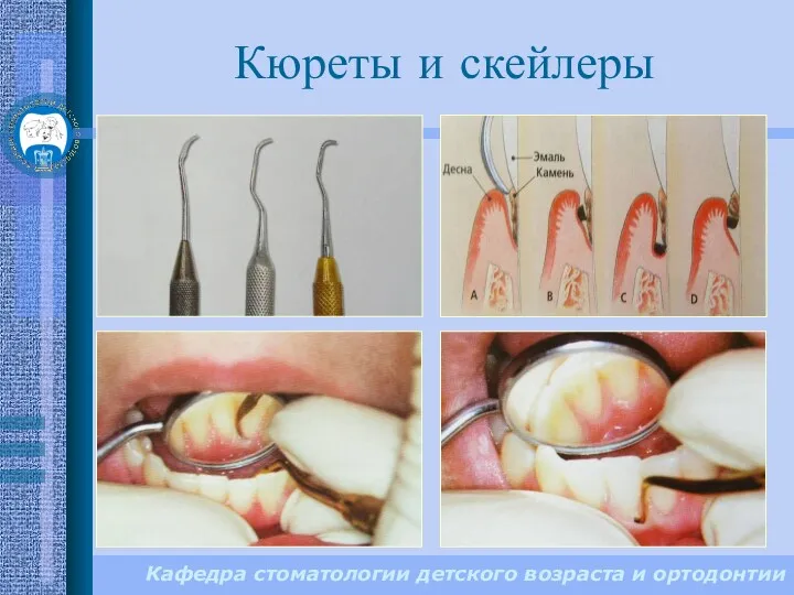Кафедра стоматологии детского возраста и ортодонтии Кюреты и скейлеры